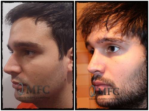 Rinoplastia
